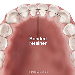 bonded lower retainer