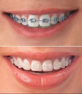 picture of clear and metal braces